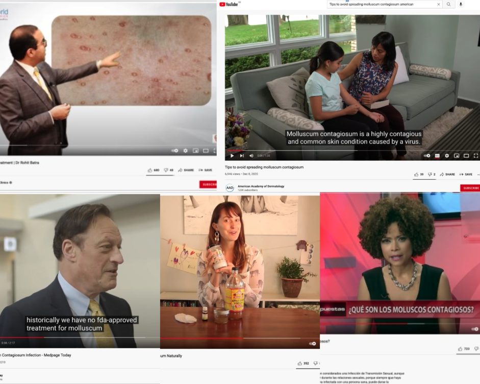 Algunas páginas webs e informaciones que tratan el molusco contagioso en la red social YouTube.