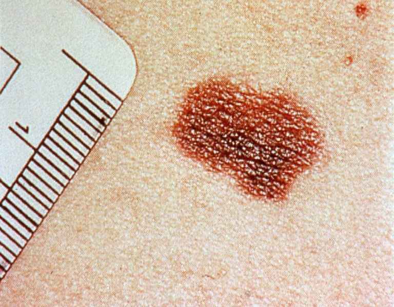 melanoma vacuna