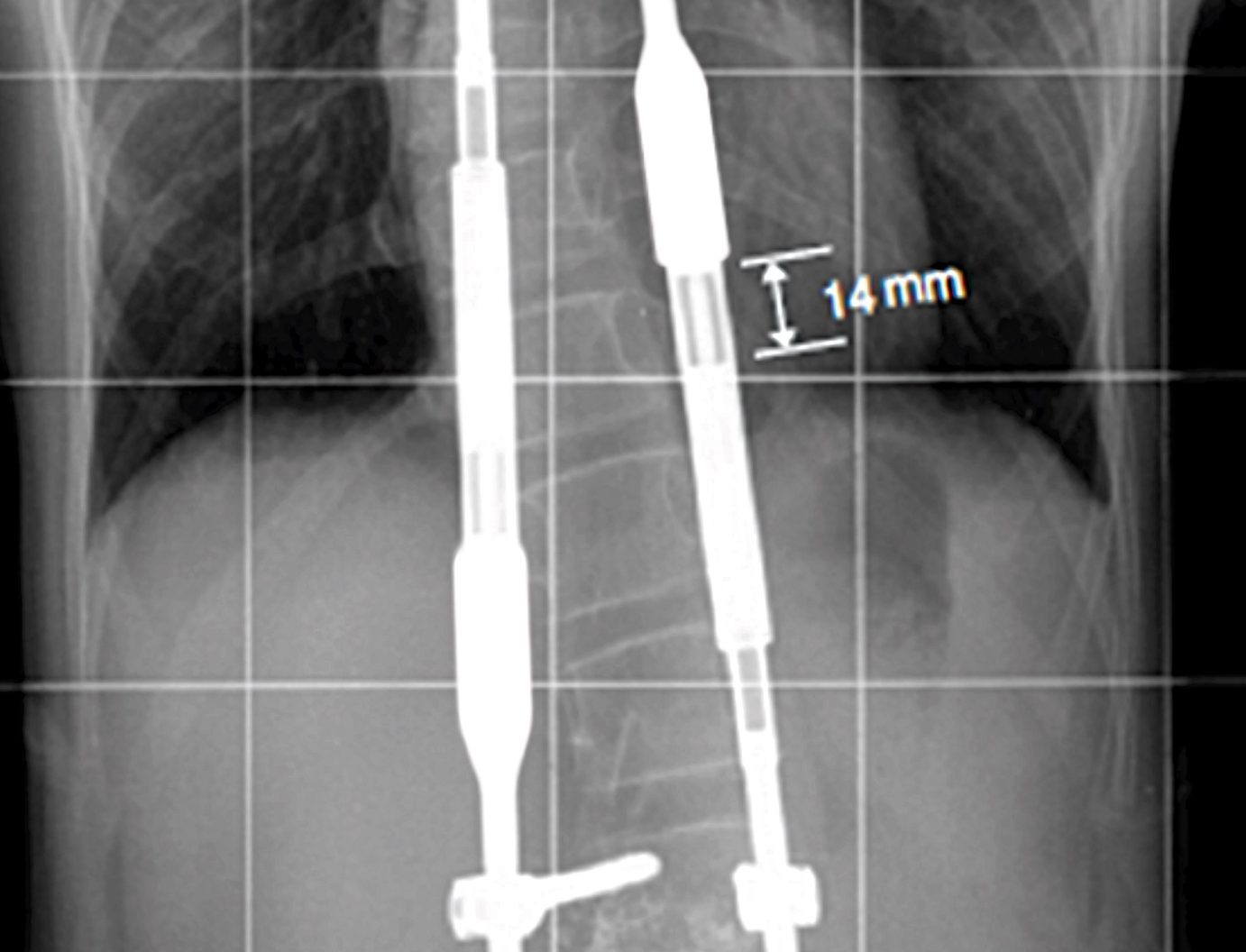 ¿Qué es la escoliosis? EFE/ Pablo Gutman
