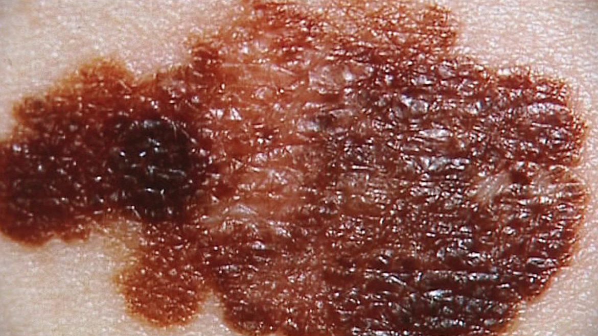 La cara contrahecha del melanoma