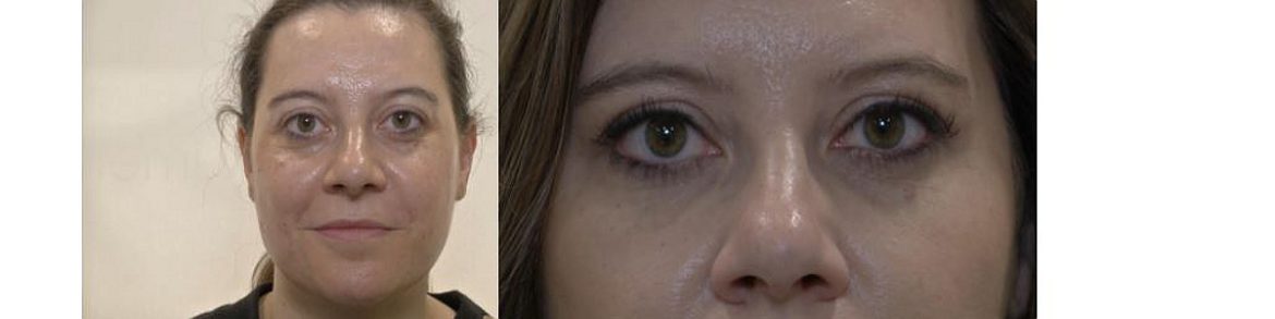 Reportaje en la Clínica IMEMA sobre rejuvenecimiento facial con Mayte, la paciente, la doctora Méndez de Vigo y el doctor López Bran.