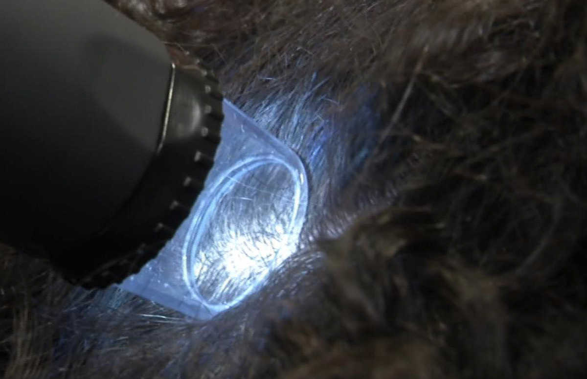 El doctor Eduardo López Bran explica, junto a una enfermera y un paciente con gran cantidad de pelo, la diferencia entre una zona donante con abundancia de folículos pilosos y otra que es insuficiente para realizar un trasplante capilar