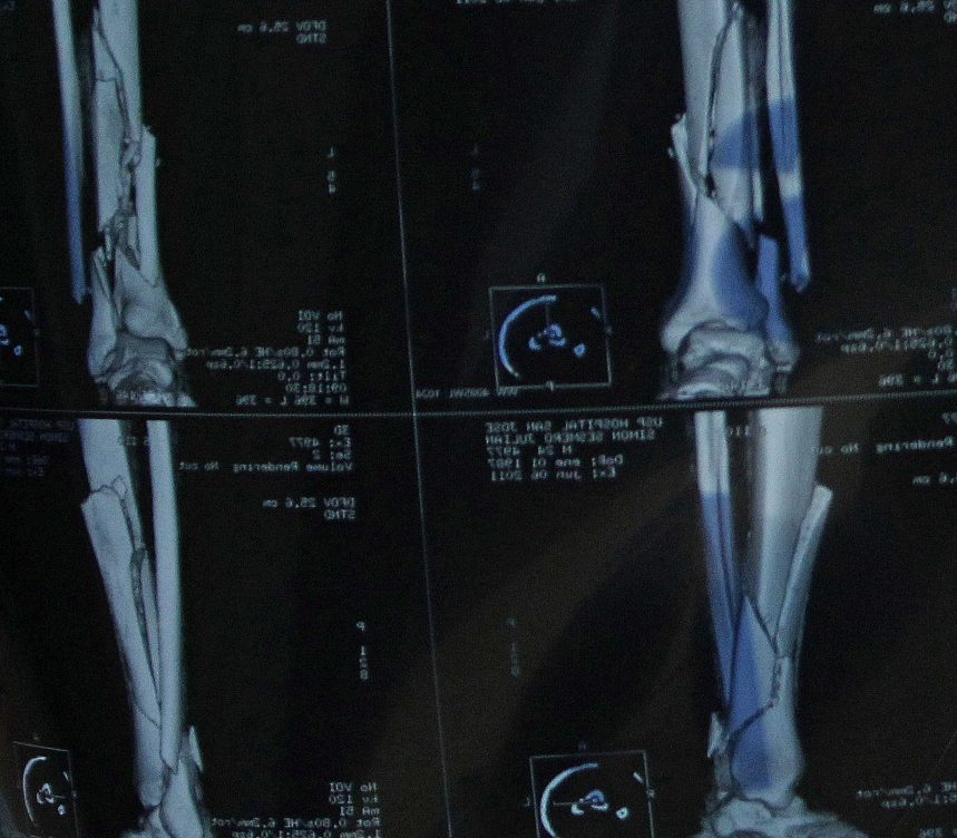 La doctora Isabel Guillén nos muestra la articulación del tobillo con los huesos del pie más la tibia y el peroné.