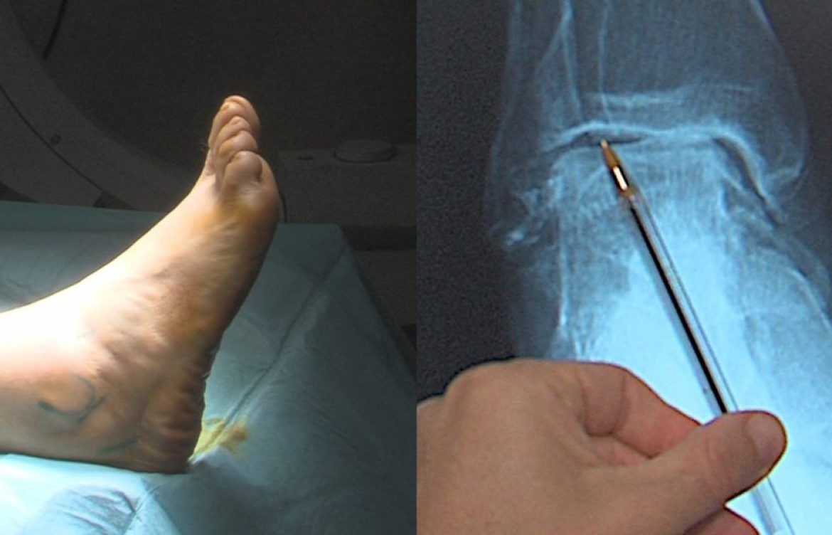 La íntima relación entre esguince, artrosis de tobillo y pie cavo varo