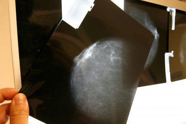 Imagen de una mamografía. EFE/Chema Moya