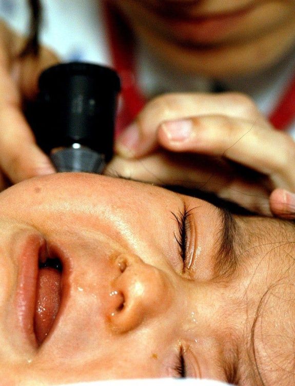 otitis