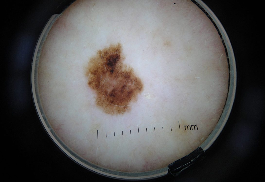 Imagen obtenida por epiluminiscencia de un melanoma cutáneo