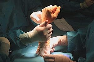 Antebrazo y mano en una operación de codo en la articulación radiocubital-efe