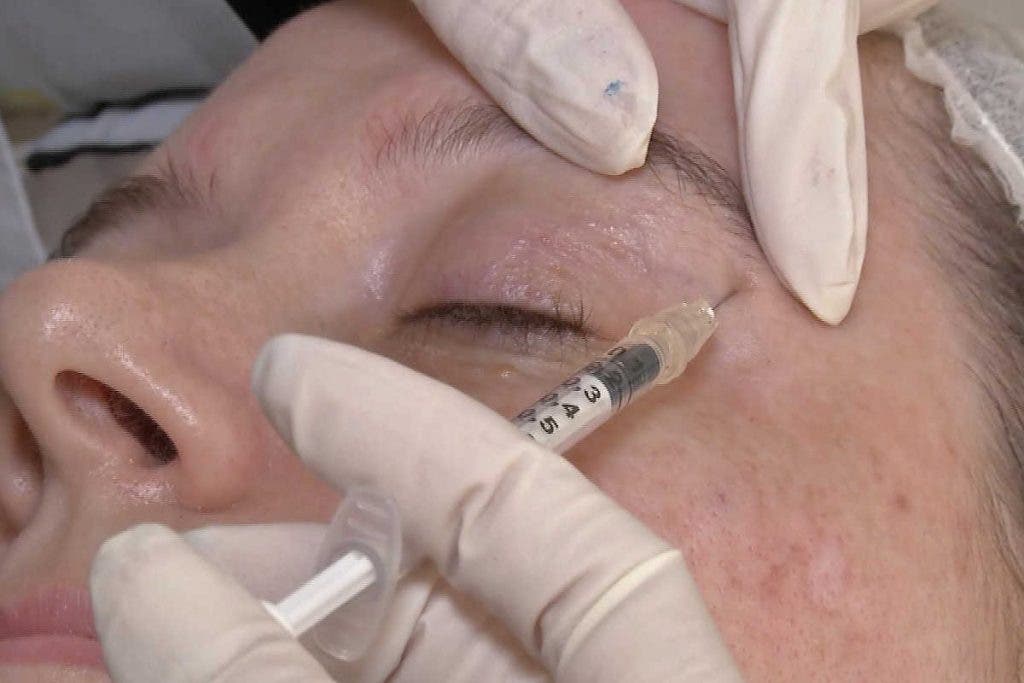 Inyección de tóxina botulínica debajo de la ceja derecha de una paciente.