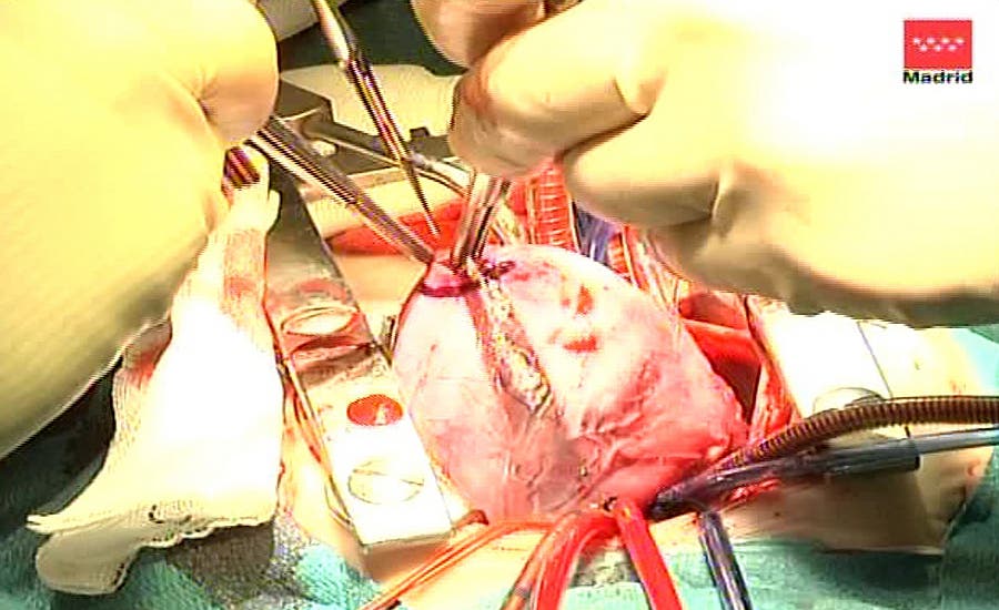 Cirugía de implante de bomba cardíaca.
