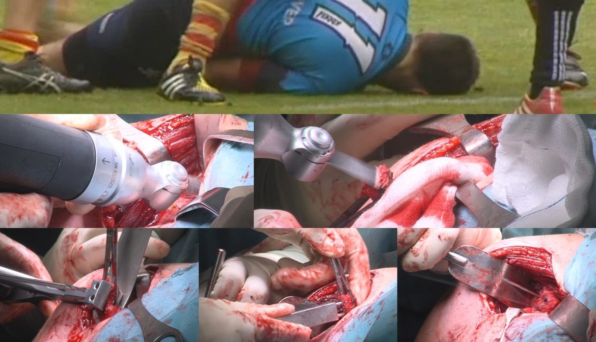 Lesión de hombro en un jugador de rugby, el cual necesita una cirugía para impedir la recidiva de la luxación-efe