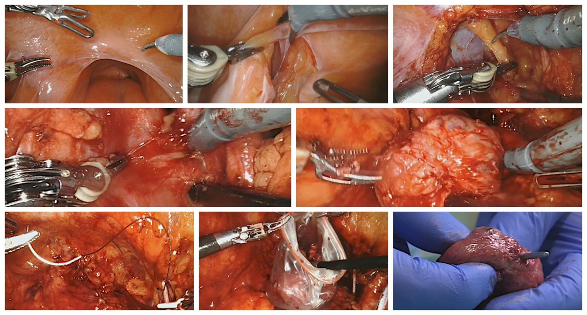 Cirugía radical de cáncer de próstata-efe