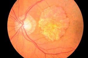 Retina afectada por DMAE seca o atrófica en la que se observa un globo ocular teñido de color naranja para distinguir los vasos sanguíneos y una zona central amarillenta.