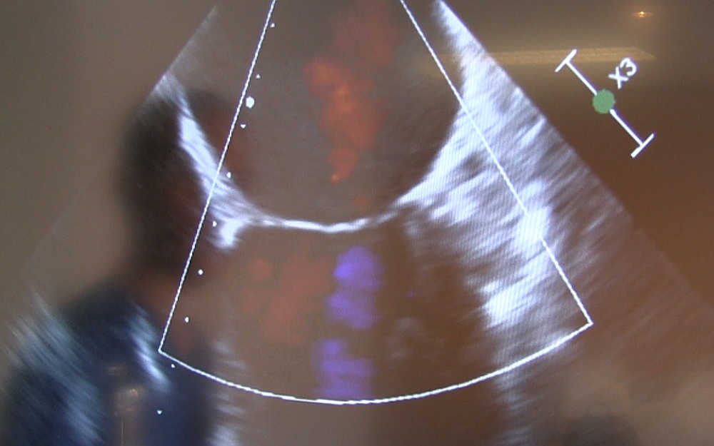 Ecocardiografía de una válvula mitral tratada con Mitraclip.