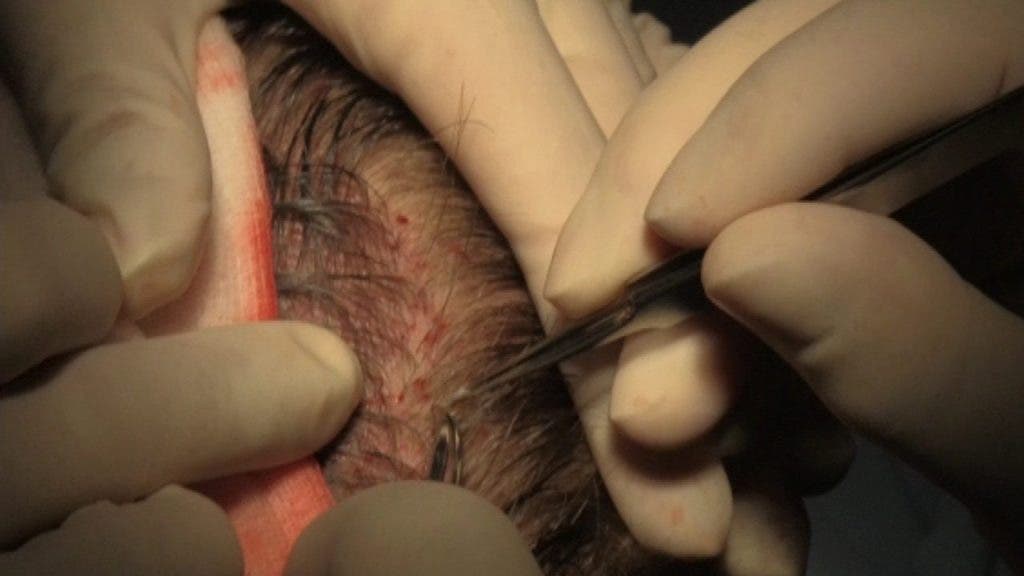 El Dr. López Bran implanta un folículo capilar en la piel de zona anterior de la cabeza de Alberto A.M.-efe