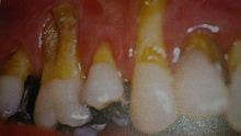 La periodontitis