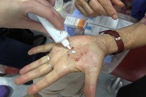 Heridas en la mano de una enferma irradiada para tratar un cáncer de cabeza y cuello