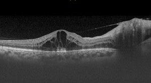 OCT de la mácula de la retina ANTES de la cirugía láser.