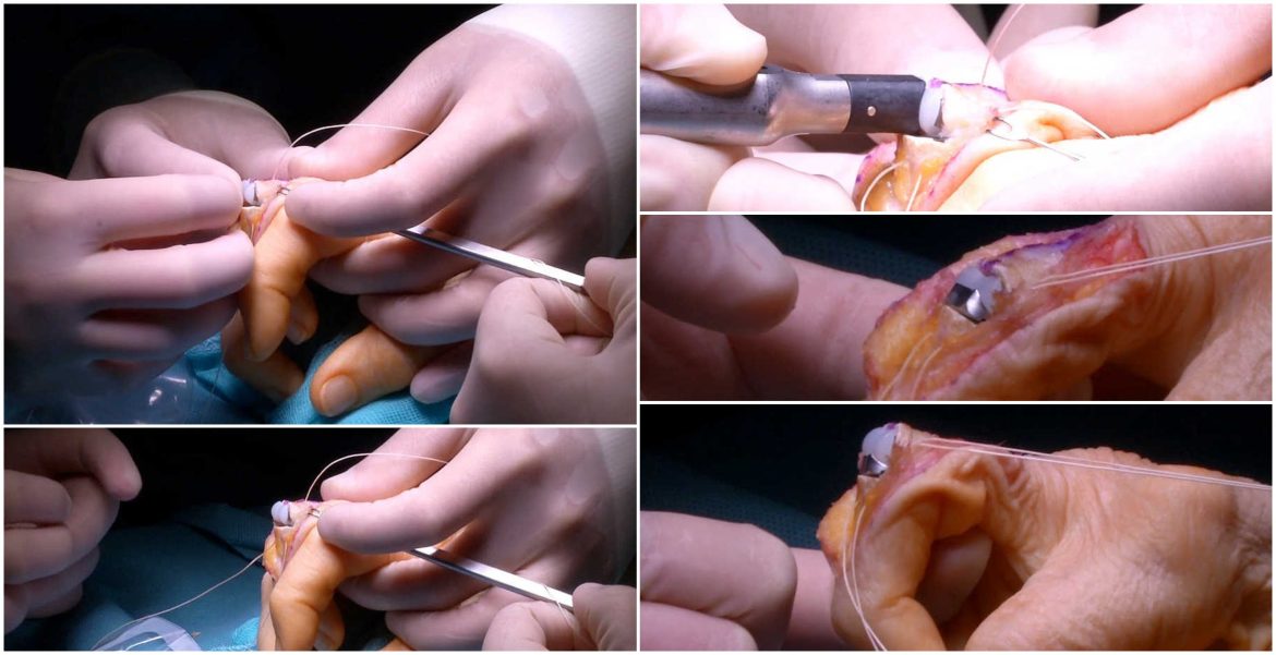 Implante articular definitivo en el dedo de una mano