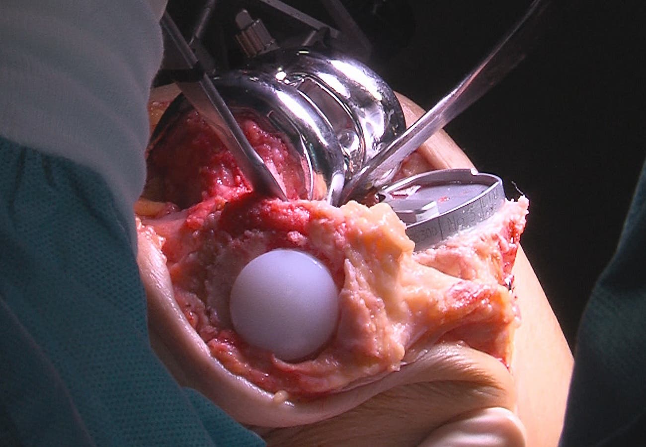 Implantes de fémur, tibia y rótula colocados en la cápsula articular-efe