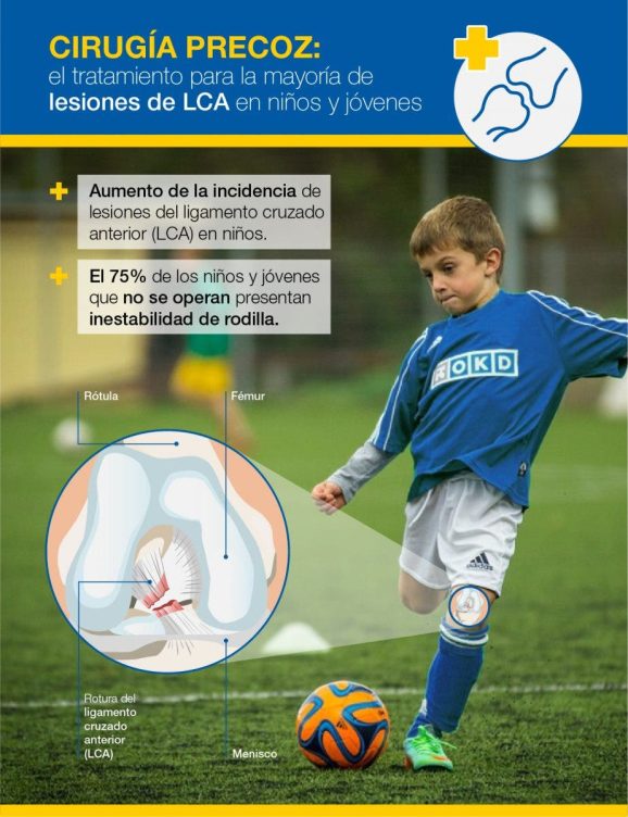 Infografia de LCA en niñ@s y adolescentes. Cedida por @clinicaCEMTRO