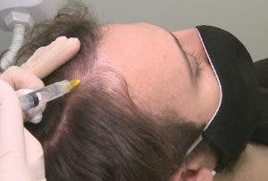 Inyección de dutasteride contra la pérdida de cabello-efe