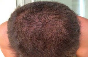 Alopecia incipiente en un joven de treinta años de edad.