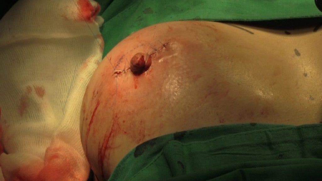 puntos de sutura sobre las heridas efectuadas sobre la mama para poder crear un pezón de carne y piel de la propia paciente. efesalud.com