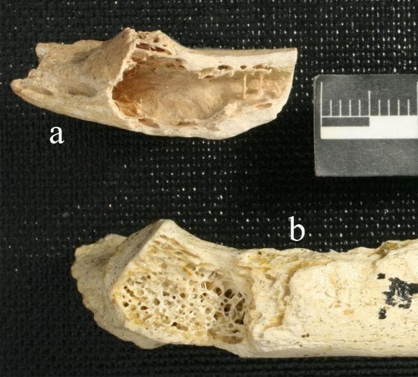 Hallan el cáncer de huesos más antiguo en un Neanderthal de hace 120.000 años