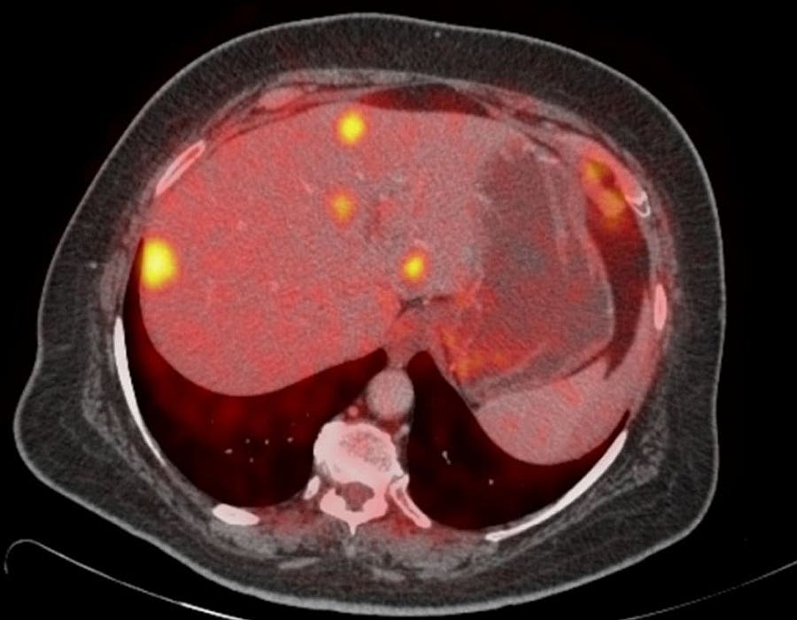 Pet con marcadores de metástasis de cáncer de pulmón en el hígado