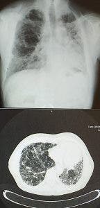 Radiografía y TAC de pulmón con Fibrosis Pulmonar Idiopática