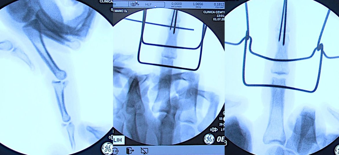 RX de operación fractura de dedo corazón-efe