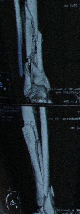 Radiografía de un fractura de tibia y peroné. 