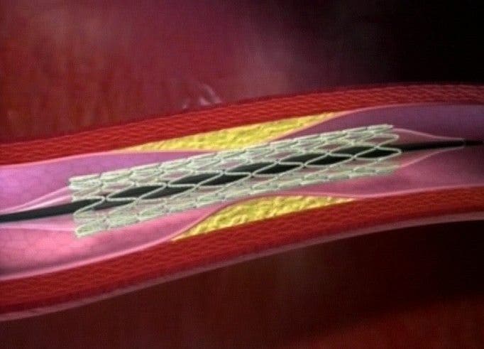 Un dispositivo stent o malla que sirve para dar luz a los vasos sanguíneos cuando se engrosan.