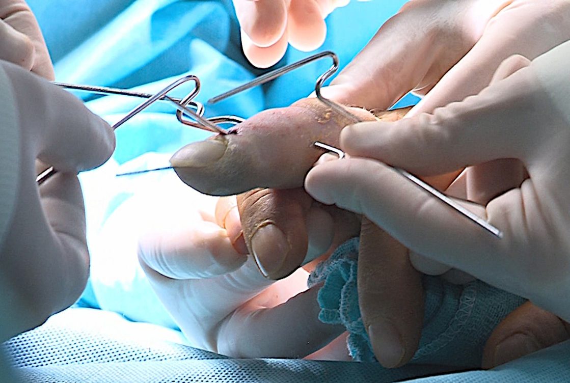 interfalángicas del dedo corazón: cirugía el alambre - EFE Salud