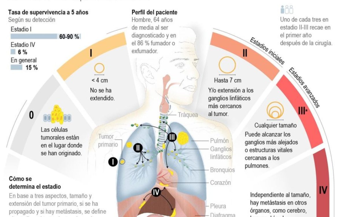 No fumar sigue siendo más efectivo que todos los avances contra el cáncer de pulmón