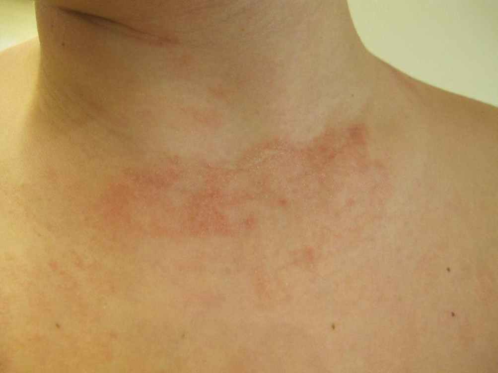 El otoño reseca la piel y agrava las molestias de la dermatitis atópica