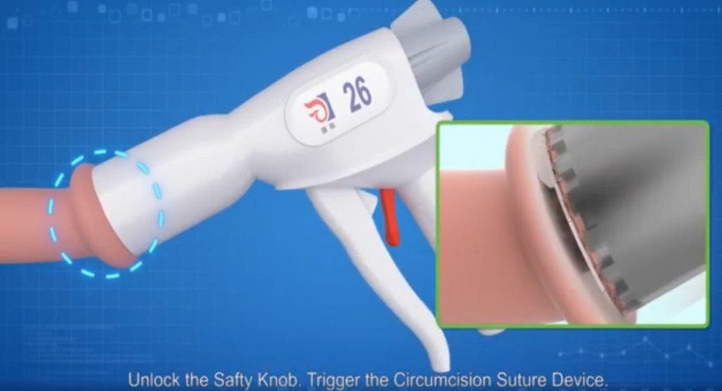 Dispositivo de circuncisión CircCurer, diseñado y basado en los principios de la grapadora de anastomosis intestinal (conexión quirúrgica entre dos estructuras). Consta de una campana para el glande, un gatillo, un bisturí circular y una grapadora de sutura.