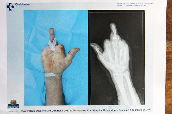 Implantación de un dedo del pie en la mano en Hospital de Cruces