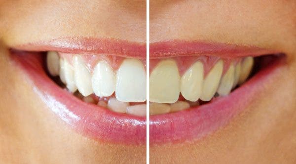 Los límites del blanqueamiento dental