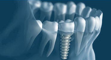 implante dientes protesis