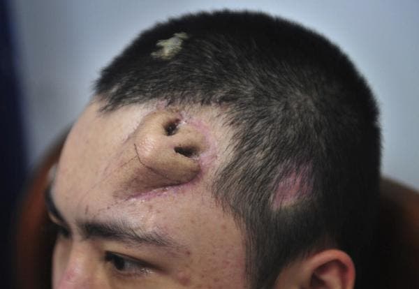 Médicos chinos “crean” una nariz en la frente a la víctima de un accidente