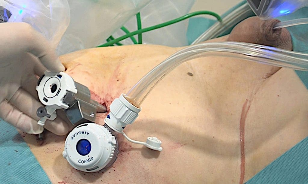 Abdomen de un paciente con los puertos para introducir el instrumental del robot Da Vinci en una operación de cáncer de próstata