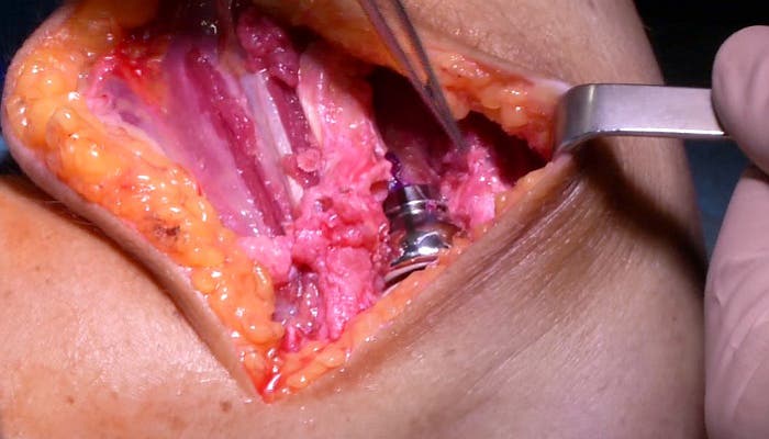 prótesis definitiva de cabeza de radio implantada en el hueso con el fin de hacer la articulación del codo-efe
