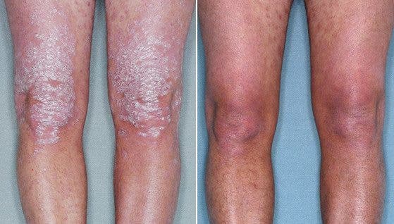 Detalle de los efectos de la psoriasis en las piernas. Efesalud.com