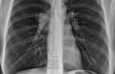 Una RX de un pulmón con tumores malignos.