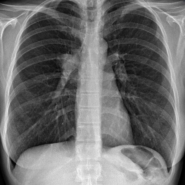Una RX de un pulmón con tumores malignos.