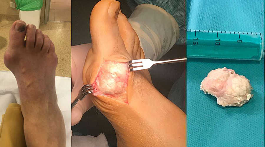 La hiperuricemia produce tofos que afectan al dedo gordo del pie