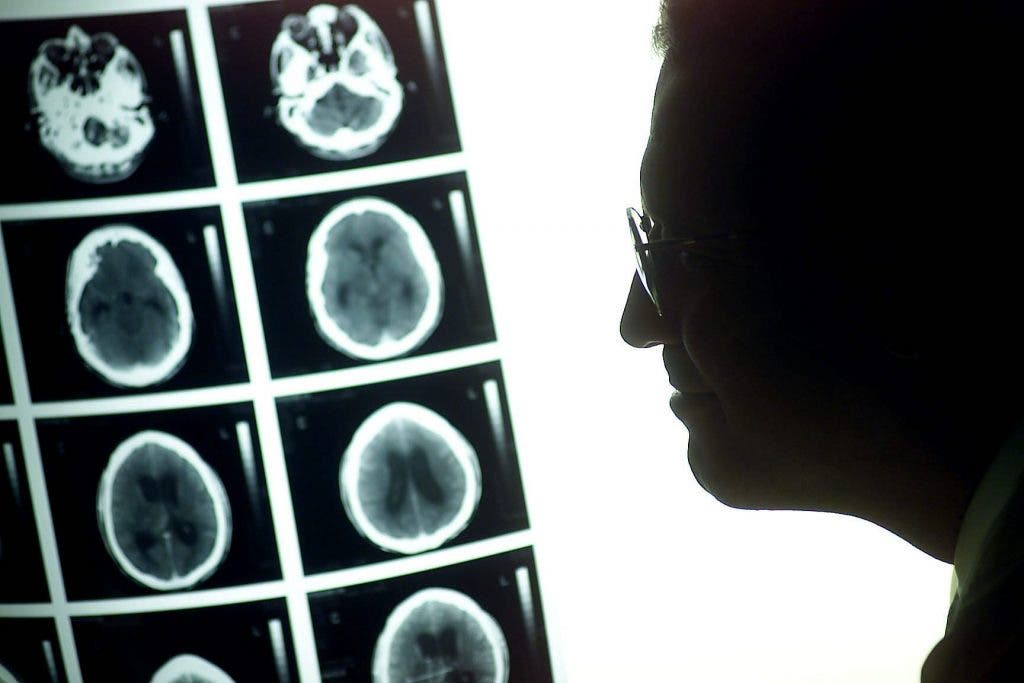 Tumor cerebral: diez casos al día, y subiendo