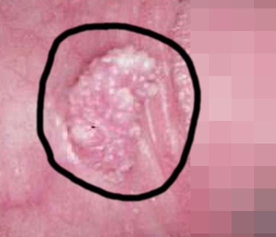 virus papiloma en glande